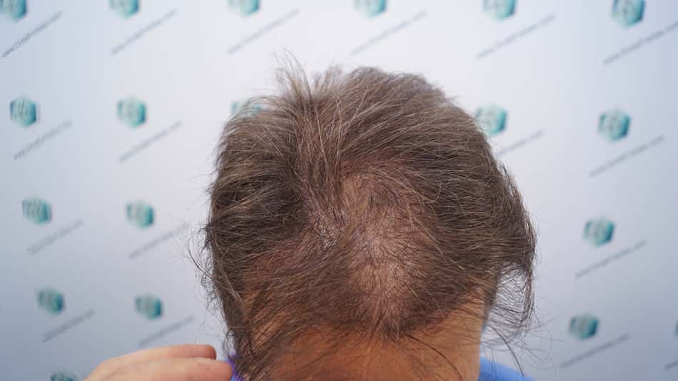alopecia difusa sem padrão