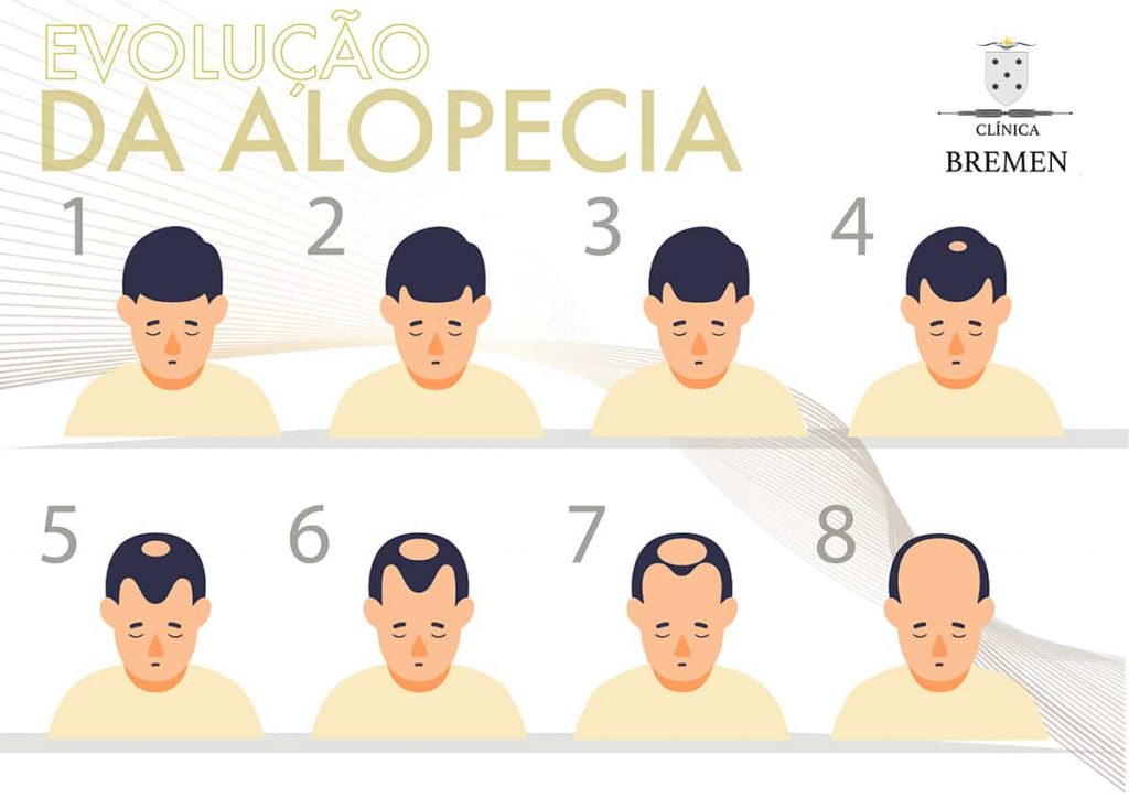 Alopecia o que é | Clínica Bremen